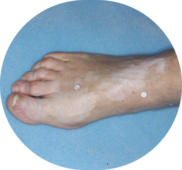 A patient's foot showing more repigmentation progress after 6 months of treatment.