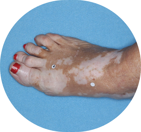 A patient with vitiligo's foot showing areas of depigmentation before treatment with OPZELURA.