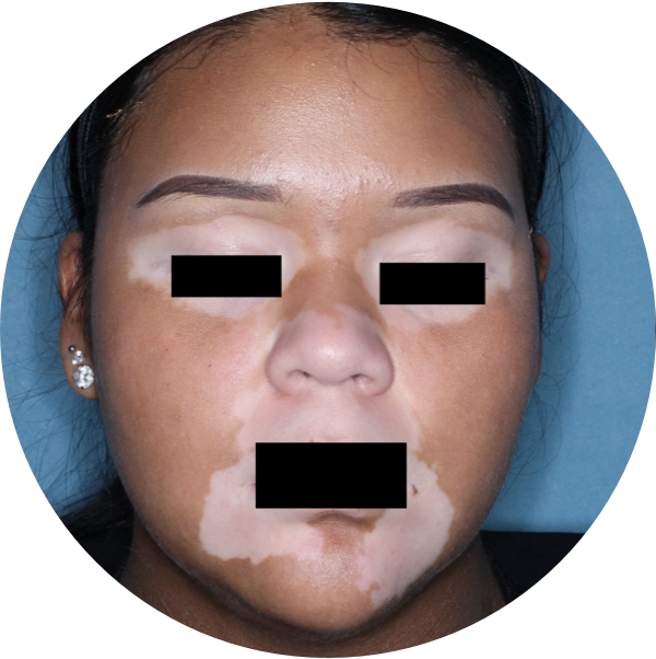 A young woman's face with depigmentation from her vitiligo before treatment with OPZELURA.