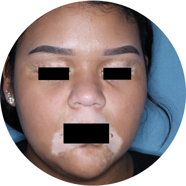 A young woman's face showing some repigmentation progress after 3 months of treatment.