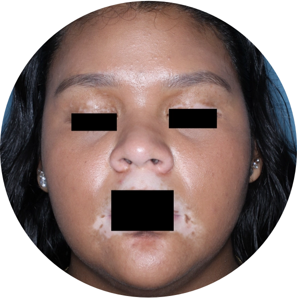 A young woman's face showing additional repigmentation after 6 months of treatment.