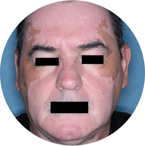A man's face showing depigmentation from his vitiligo before treatment with OPZELURA.