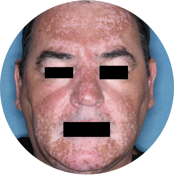 A man's face showing progress with repigmentation after 3 months of treatment.