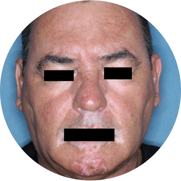 A man's face showing additional repigmentation after 6 months of treatment.