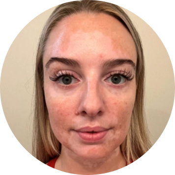 A young woman's face with vitiligo, showing results: 85% facial repigmentation at 12 months of treatment.