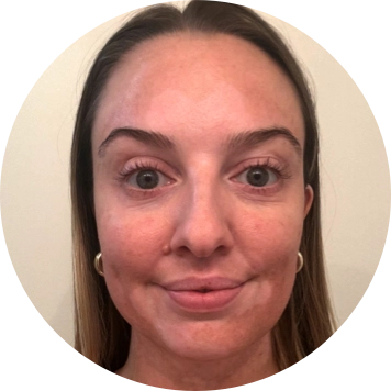 A young woman's face with vitiligo, showing more repigmentation progress at 2 years of treatment.
