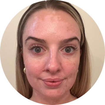 A young woman's face with vitiligo, showing more repigmentation progress at 8 months of treatment.