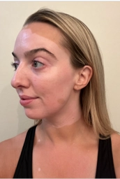 A young woman's face with vitiligo, showing more repigmentation progress at 2 years of treatment.