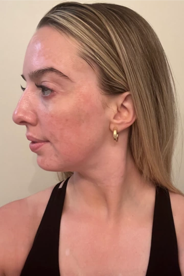 A young woman's face with vitiligo, showing more repigmentation progress at 8 months of treatment.