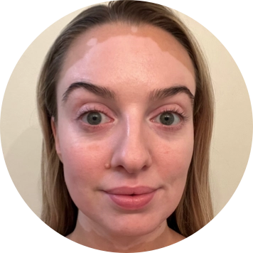 A young woman's face with vitiligo, showing depigmentation before treatment with OPZELURA.