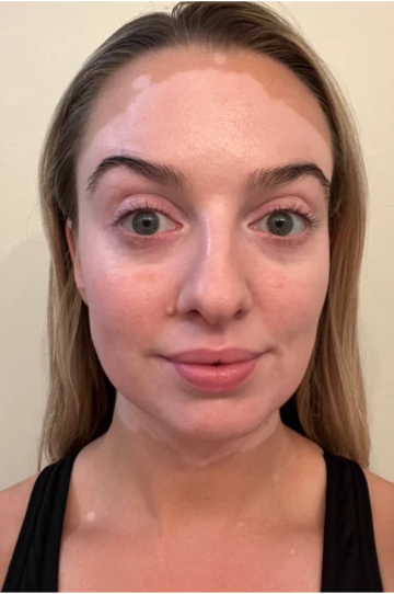 A young woman's face with vitiligo, showing depigmentation before treatment with OPZELURA.