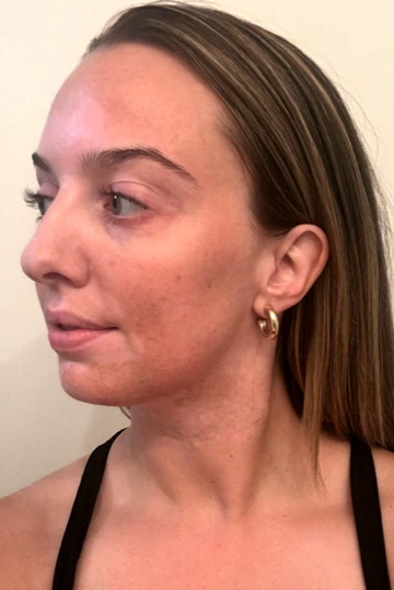 A young woman's face with vitiligo, showing more repigmentation progress at 2 years of treatment with OPZELURA.