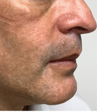 Patient's face after 27 weeks of treatment with OPZELURA