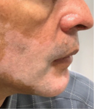 Patient's face before treatment with OPZELURA
