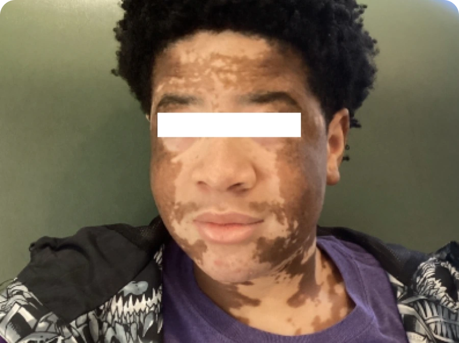 Patient's face after 5 months of treatment with OPZELURA.