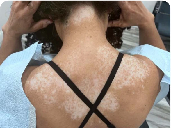 Patient's back after 9 months of treatment with OPZELURA.