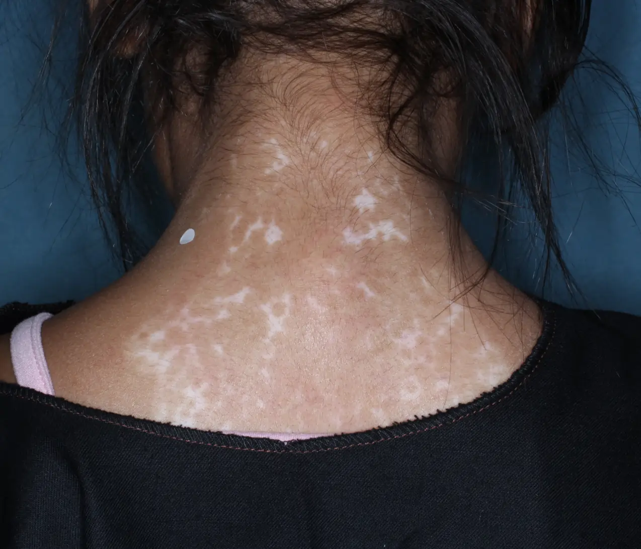 Back of patient's neck showing repigmentation progress after 6 months of treatment with OPZELURA.