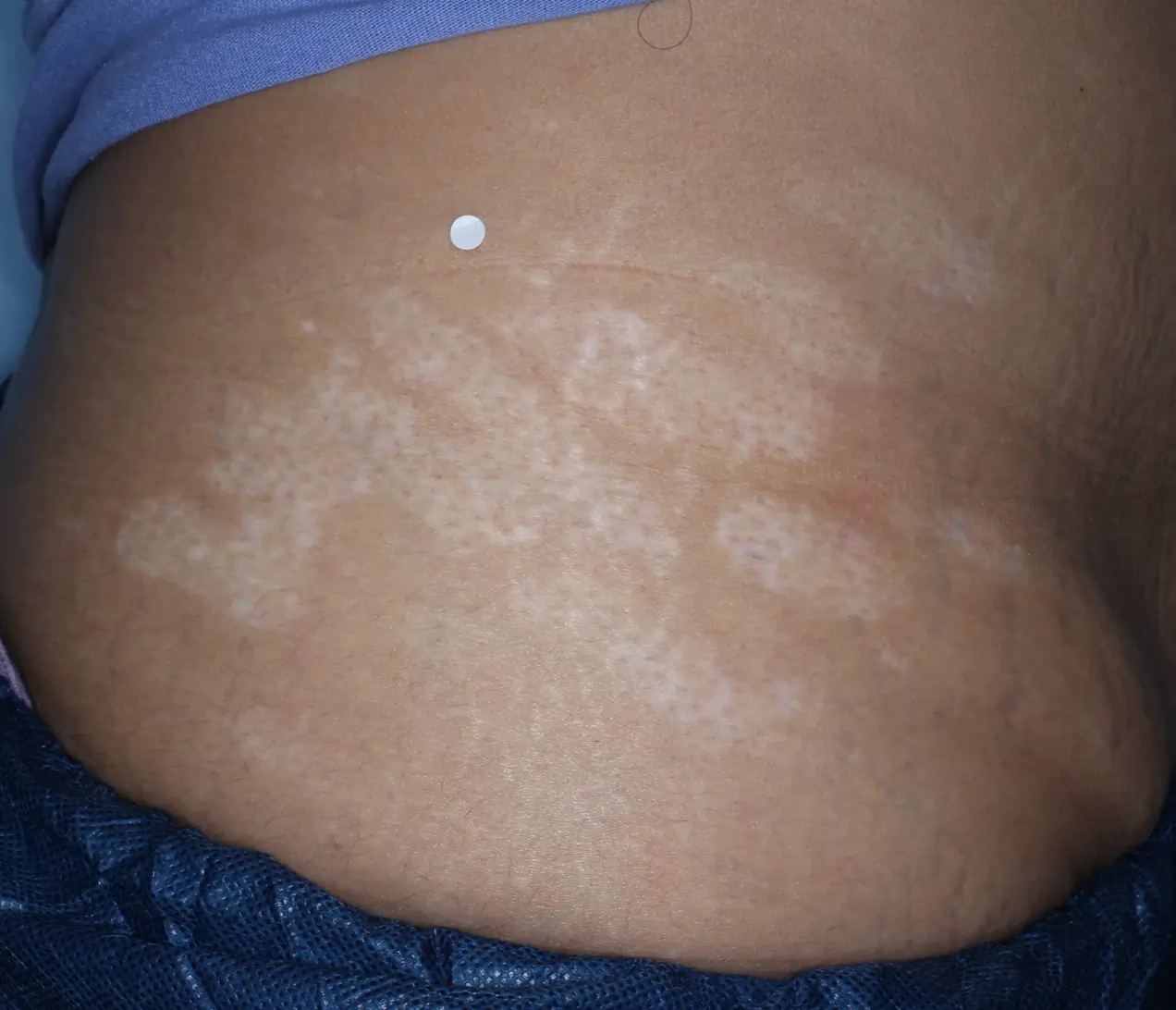 Patient's abdomen showing repigmentation progress after 1 year of treatment with OPZELURA.