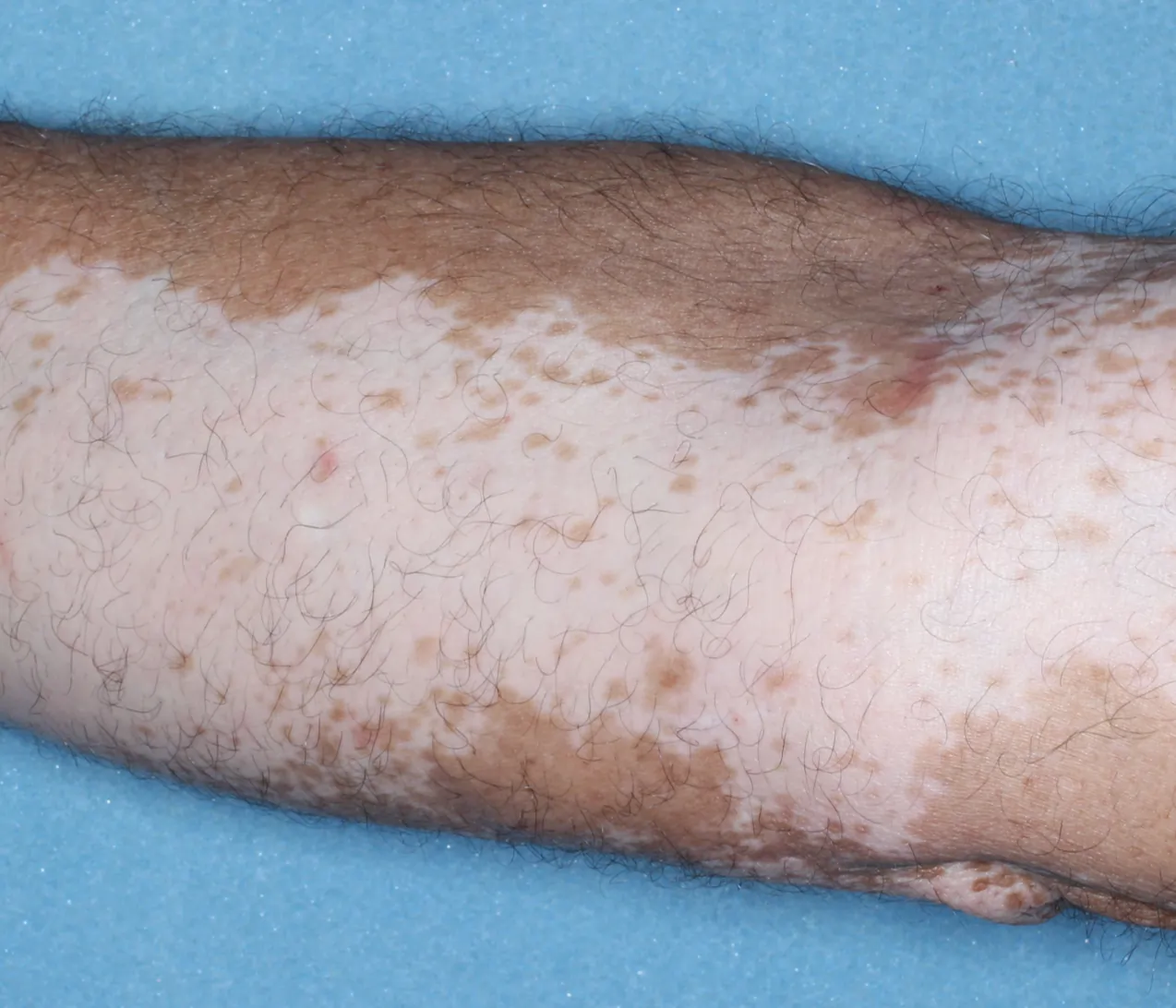 Patient's arm showing repigmentation progress after 6 months of treatment with OPZELURA.