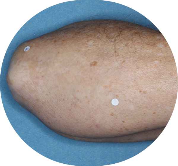 A patient's elbow and forearm showing more repigmentation progress after 6 months of treatment.