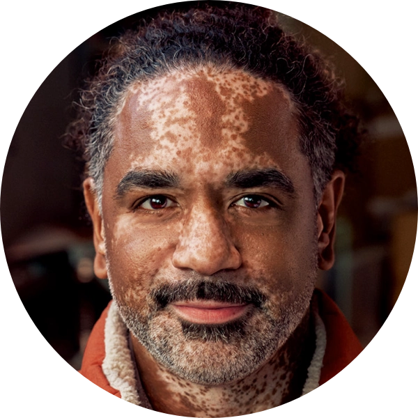 Visualization after 3 months of treatment with OPZELURA