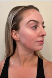 A young woman's face with vitiligo, showing more repigmentation progress at 2 years of treatment.