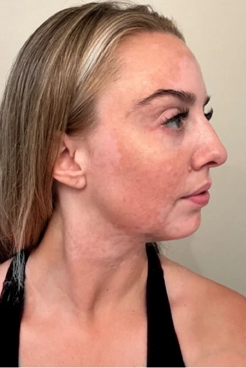 A young woman with vitiligo's face, showing more repigmentation progress at 12 months of treatment.