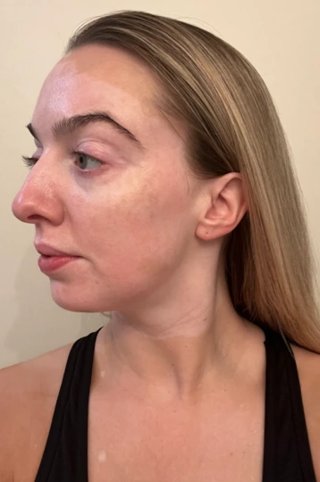 A young woman's face with vitiligo, showing repigmentation progress at 2 months of treatment with OPZELURA.