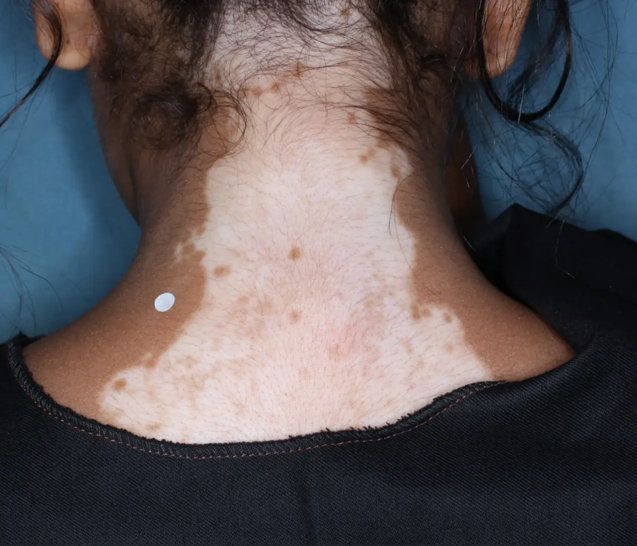 Back of patient's neck before treatment with OPZELURA.