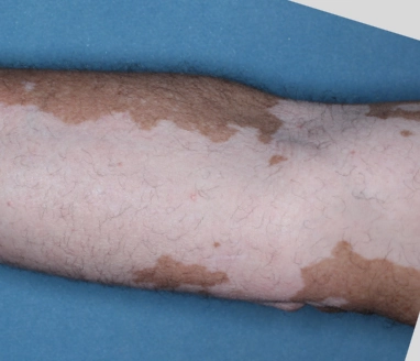 Patient's arm before treatment with OPZELURA.