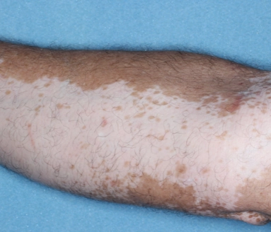Patient's arm showing repigmentation progress after 6 months of treatment with OPZELURA.