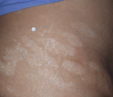 Patient's abdomen showing repigmentation progress after 1 year of treatment with OPZELURA.