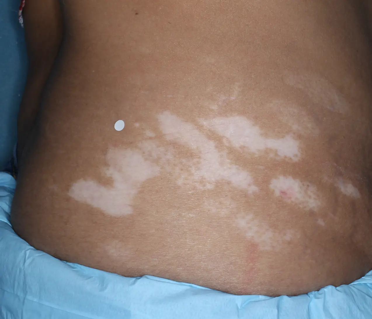 Patient's abdomen before treatment with OPZELURA.