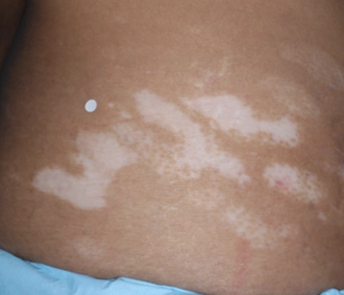Patient's abdomen before treatment with OPZELURA.