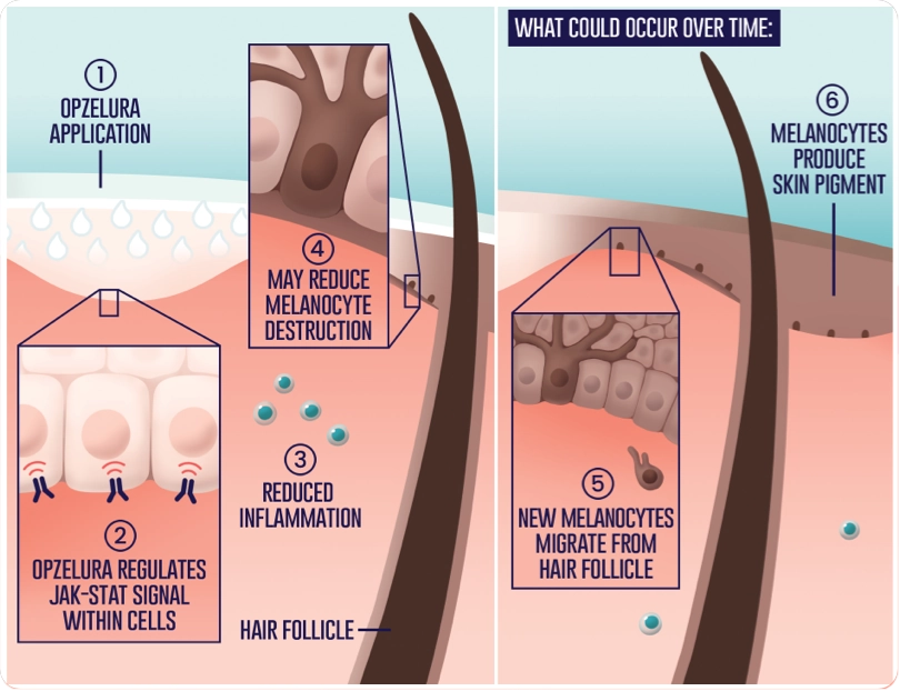 OPZELURA is applied and regulates the JAK-STAT signal within cells, which reduces inflammation and may reduce melanocyte destruction. Over time, new melanocytes may migrate from a hair follicle and produce skin pigment.