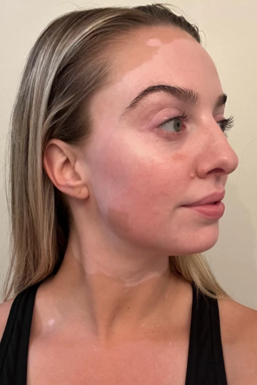 A young woman's face with vitiligo, showing depigmentation before treatment with OPZELURA.