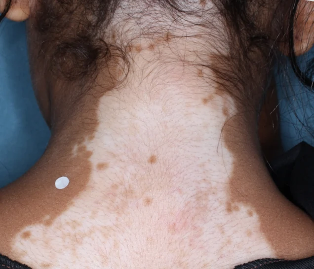 Back of patient's neck before treatment with OPZELURA.