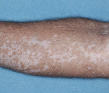 Patient's arm showing repigmentation progress after 1 year of treatment with OPZELURA.