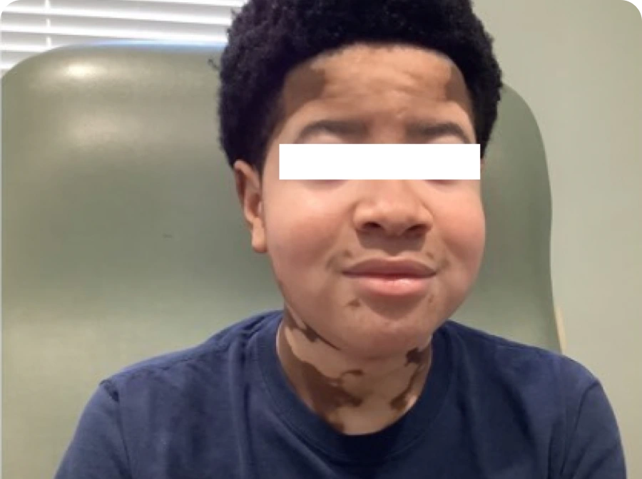 Patient's face before treatment with OPZELURA, at baseline.