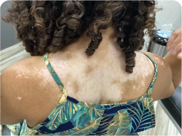 Patient's back after 3 months of treatment with OPZELURA.