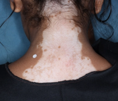 Back of patient's neck before treatment with OPZELURA.