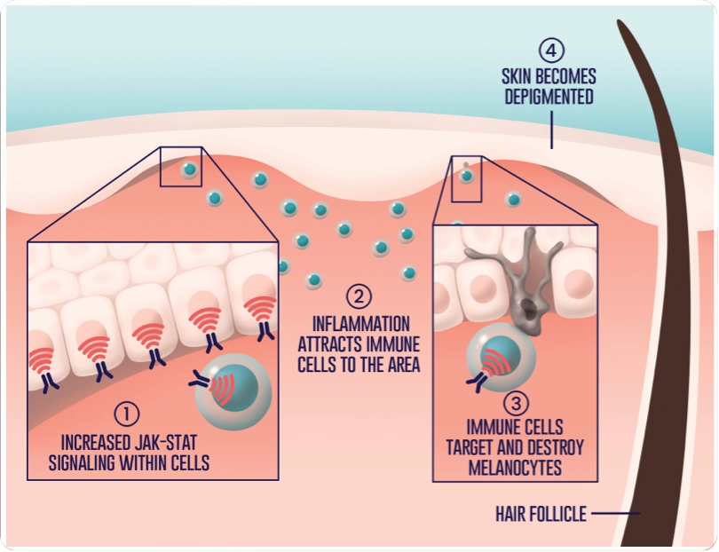 Increased JAK-STAT signaling within cells causes inflammation which attracts immune cells to the area. Immune cells target and destroy melanocytes and skin becomes depigmented.