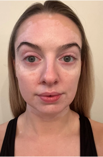 A young woman's face with vitiligo, showing repigmentation progress at 2 months of treatment with OPZELURA.