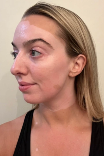 A young woman's face with vitiligo, showing depigmentation before treatment with OPZELURA.