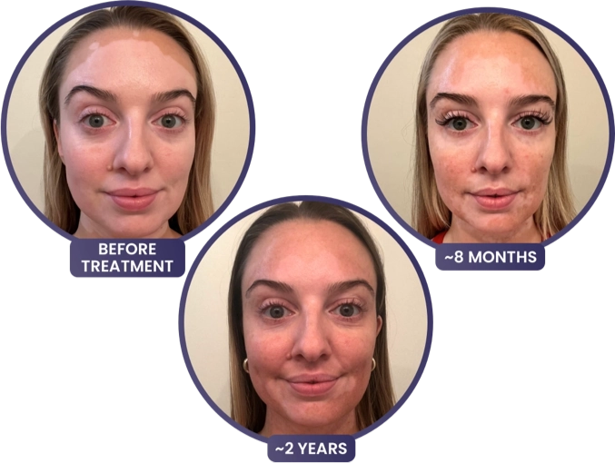 A young woman's face with vitiligo, showing depigmentation before treatment with OPZELURA and repigmentation progress at both 8 months and 2 years of treatment with OPZELURA.