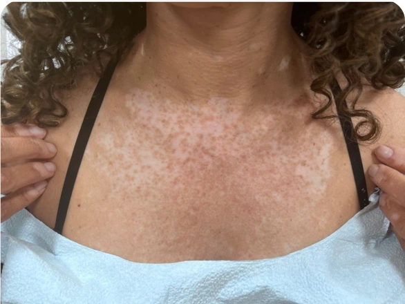 Patient's chest after 9 months of treatment with OPZELURA.