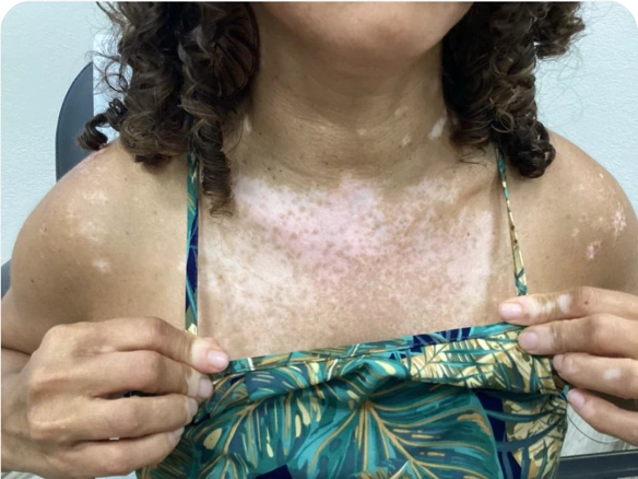 Patient's chest after 3 months of treatment with OPZELURA.