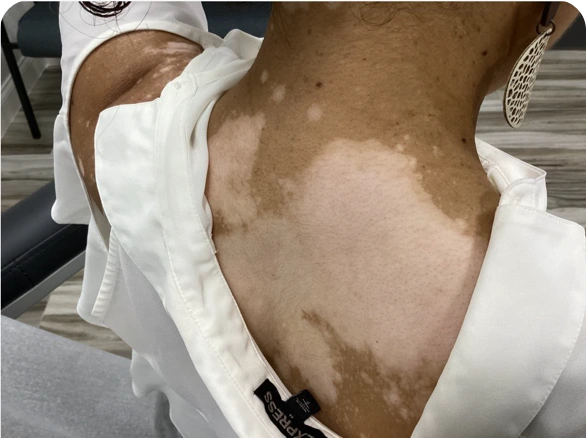 Patient's back before treatment with OPZELURA, at baseline.