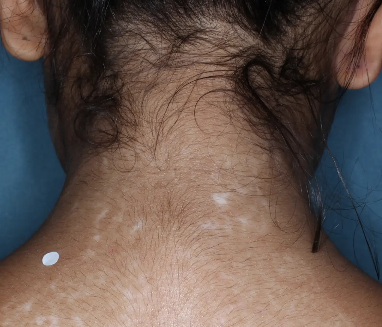 Back of patient's neck showing repigmentation progress after 1 year of treatment with OPZELURA.