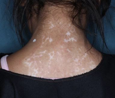 Back of patient's neck showing repigmentation progress after 6 months of treatment with OPZELURA.